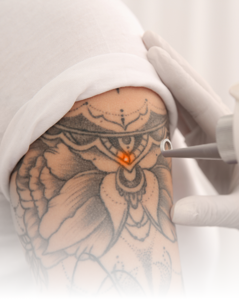 Eliminación Tatuaje