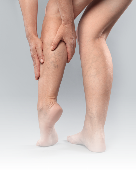 Varices